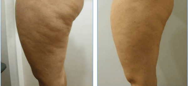 Drenagem-linfática-antes-e-depois