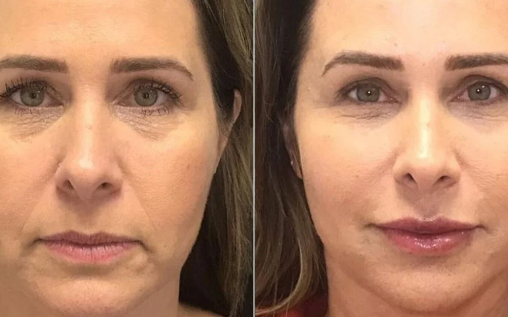 Harmonização Facial em Sorocaba: Transforme sua Beleza com Especialistas de Primeira Linha